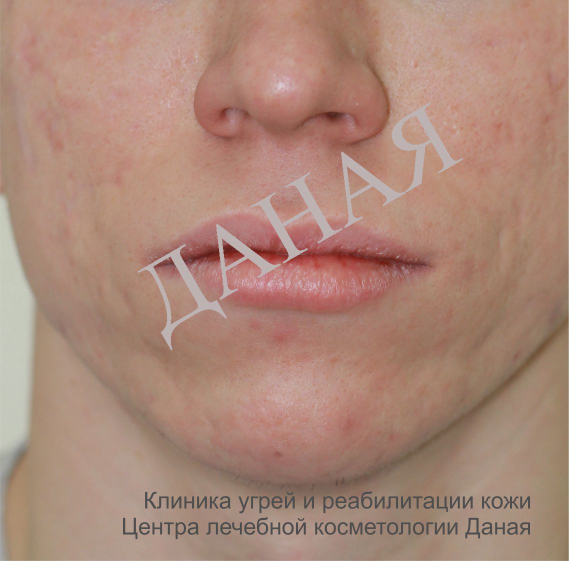 После